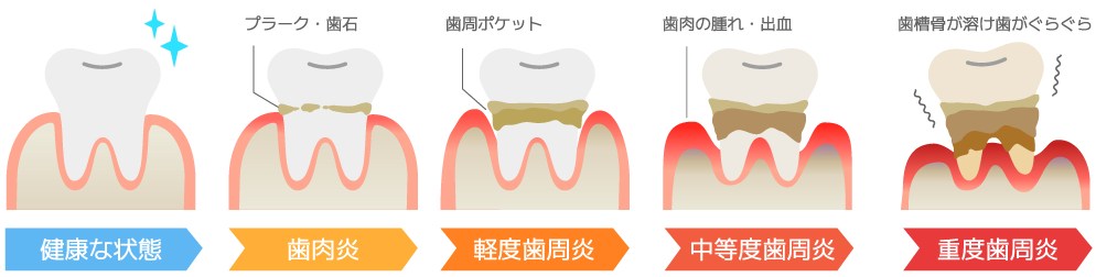 歯周病の進行図