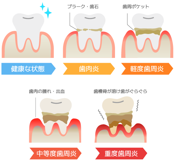 歯周病の進行図